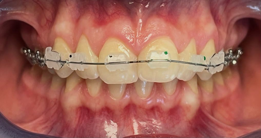 Porselen braketlerle sabit ortodontik tedavi uygulaması
